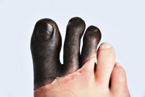 57-1.脚趾冻伤\u iStock \u 000010803966大型