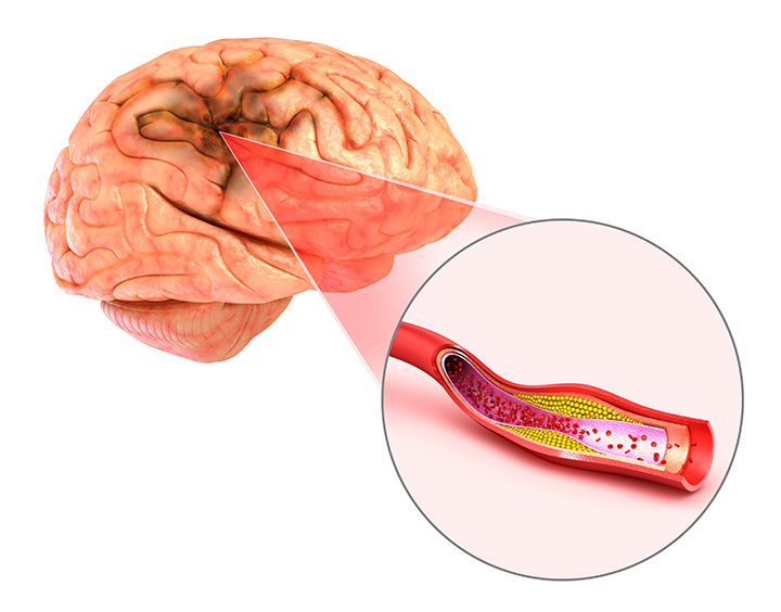 Stroke-Prevention-For-Women